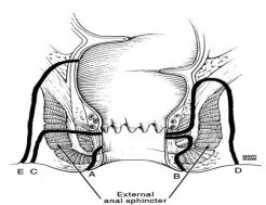 Anal Fistula