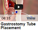 Gastrostomy Tube Placement