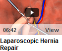 Laparoscopic Hernia Repair